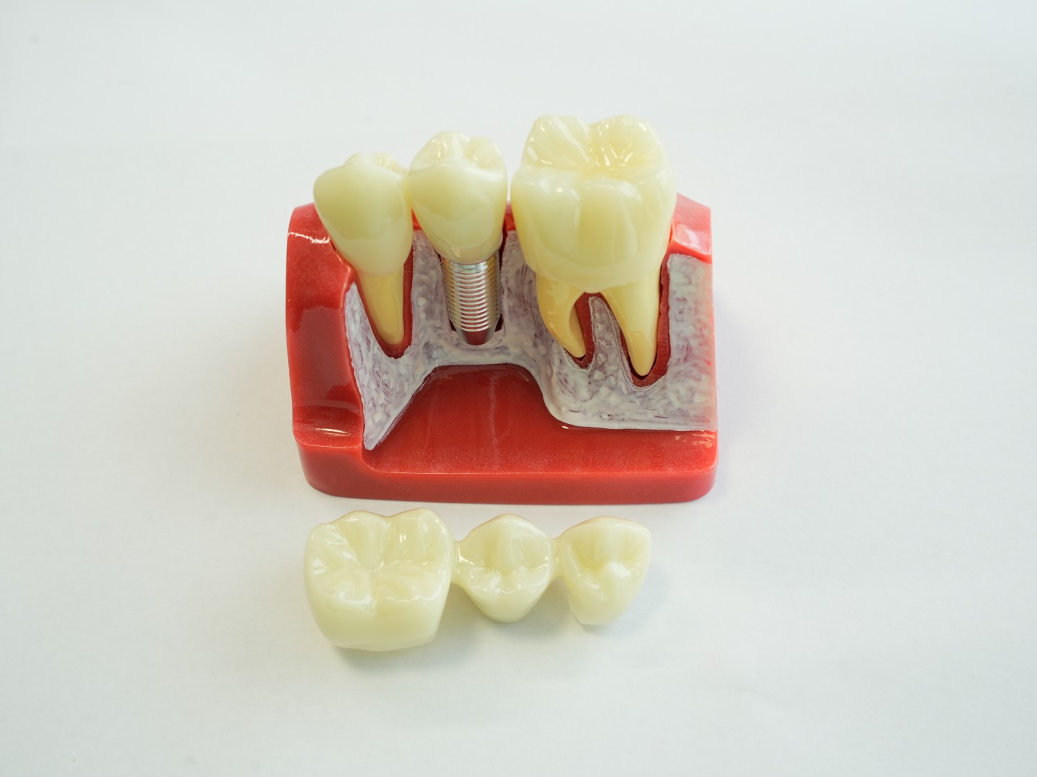 Dental Implant Teeth Model