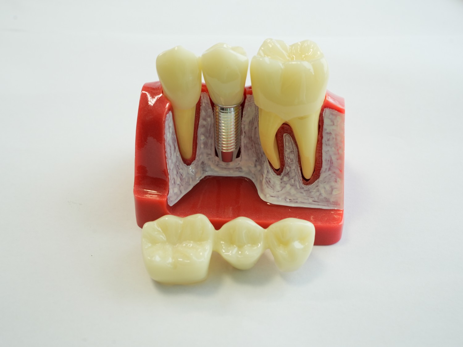 Dental Implant Teeth Model