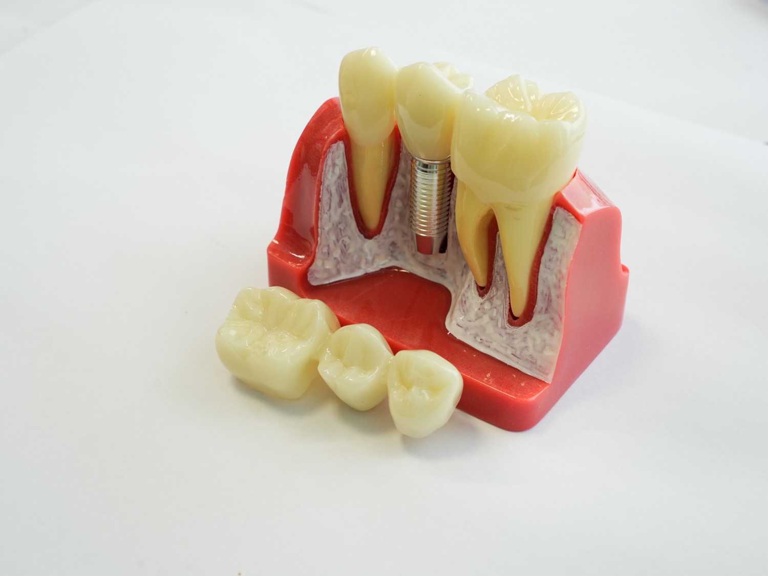 Dental Implant Teeth Model