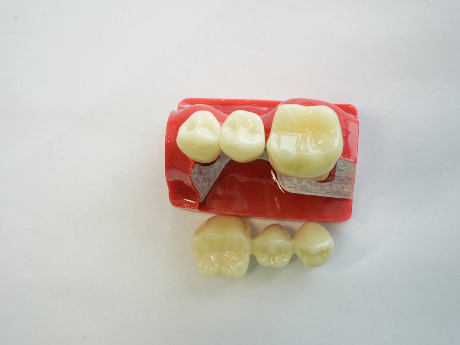 Dental Implant Teeth Model